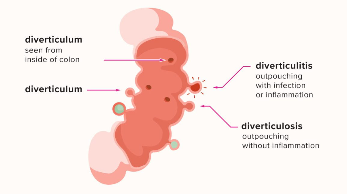 Diverticulosis - Essential Oils Center